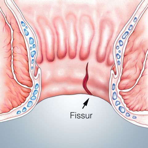 Analfissur Ksw 