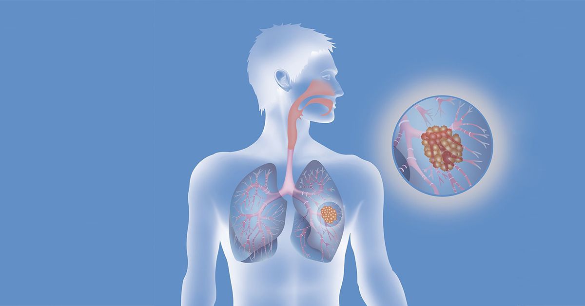 Lungenkrebs: Illustration der Lunge mit Tumor