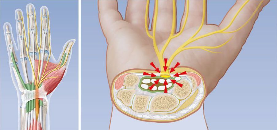 Karpaltunnelsyndrom Ursachen Symptome Behandlung Ksw