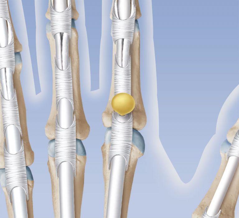 Ringbandganglion - Ursachen, Symptome und Behandlung - KSW