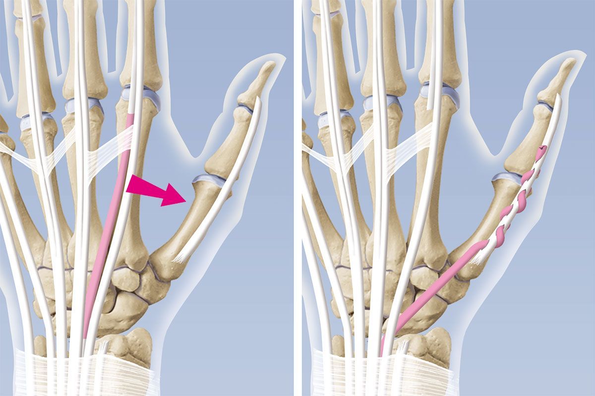 EPL-Ruptur / Riss der langen Daumenstrecksehne