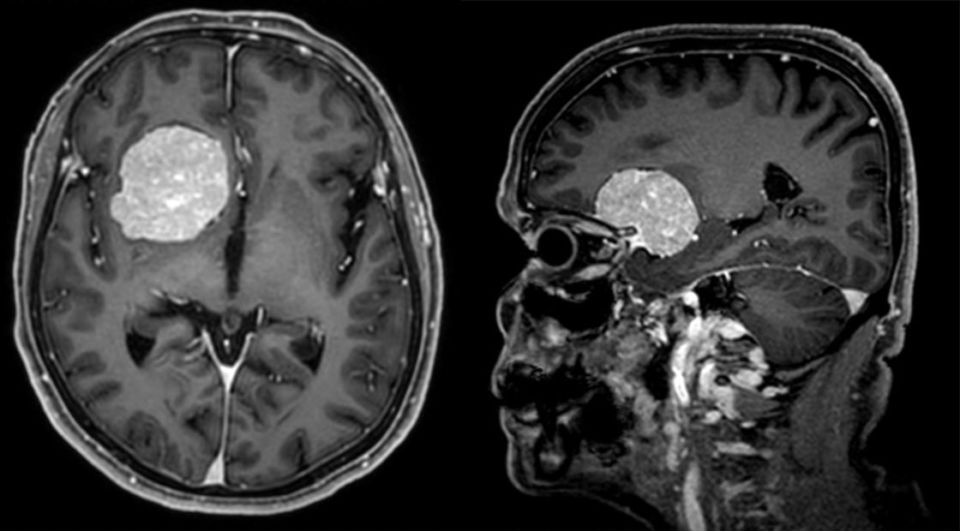 Hirntumor / Gehirntumor Diagnose und Behandlung KSW
