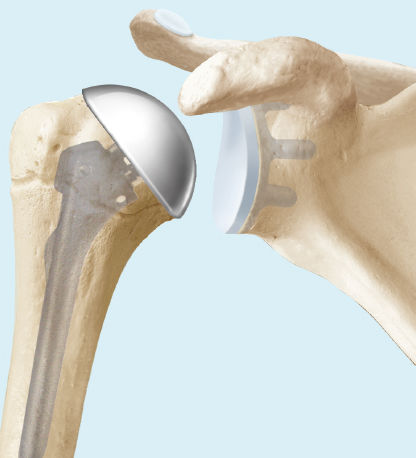 Schulterarthrose / Schulterprothese - Behandlung - KSW