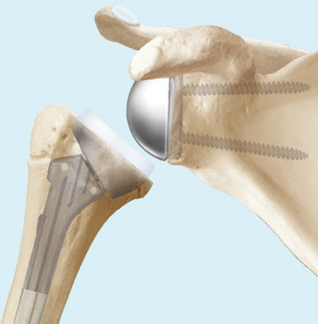 Inverse Schulterprothese