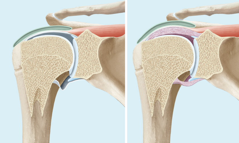 Normale und verdickte Schulterkapsel
