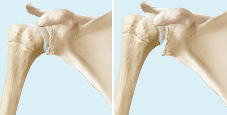 Schulterarthrose / Schulterprothese - Behandlung - KSW