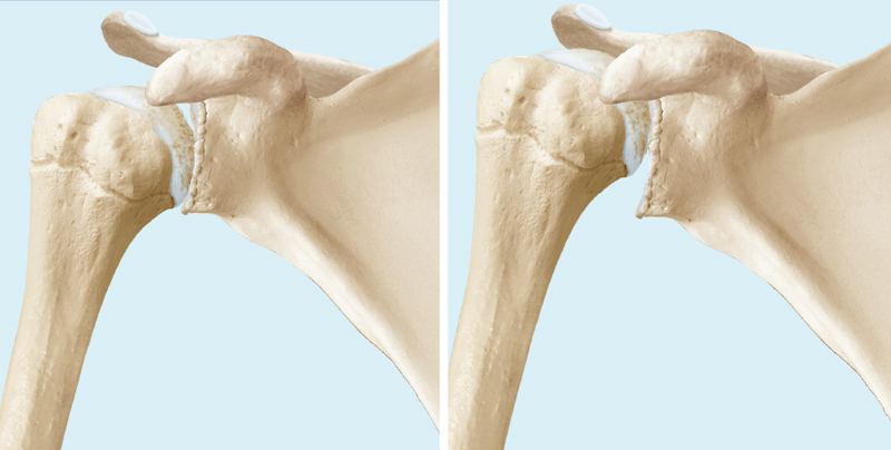 Schulterarthrose