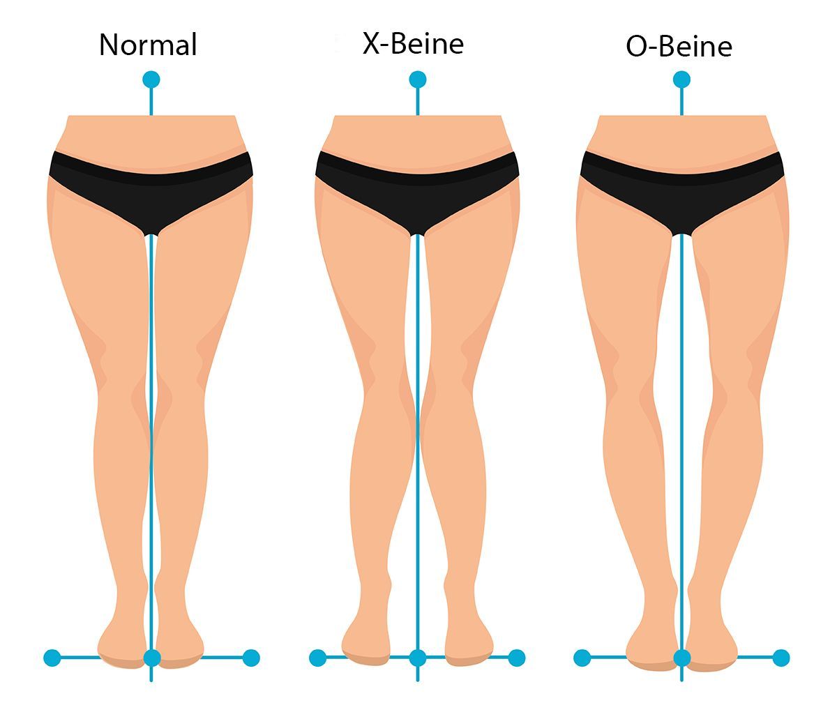 Beine tun hässliche was Cellulite: So