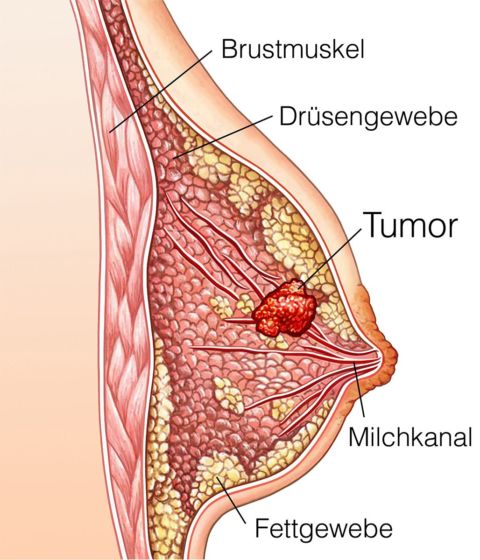 Mann knoten unter brustwarze Knoten und