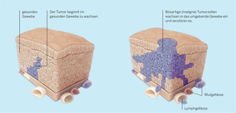Können Gutartige Tumore Bösartig Werden www.ksw.ch