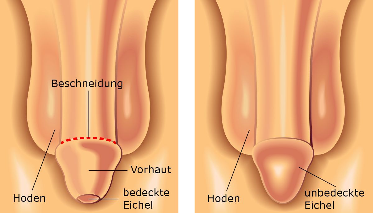 Eichel an der wunde stelle Forum für