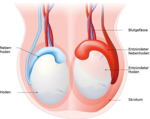 Rechter linker nebenhoden größer als Linker Hoden