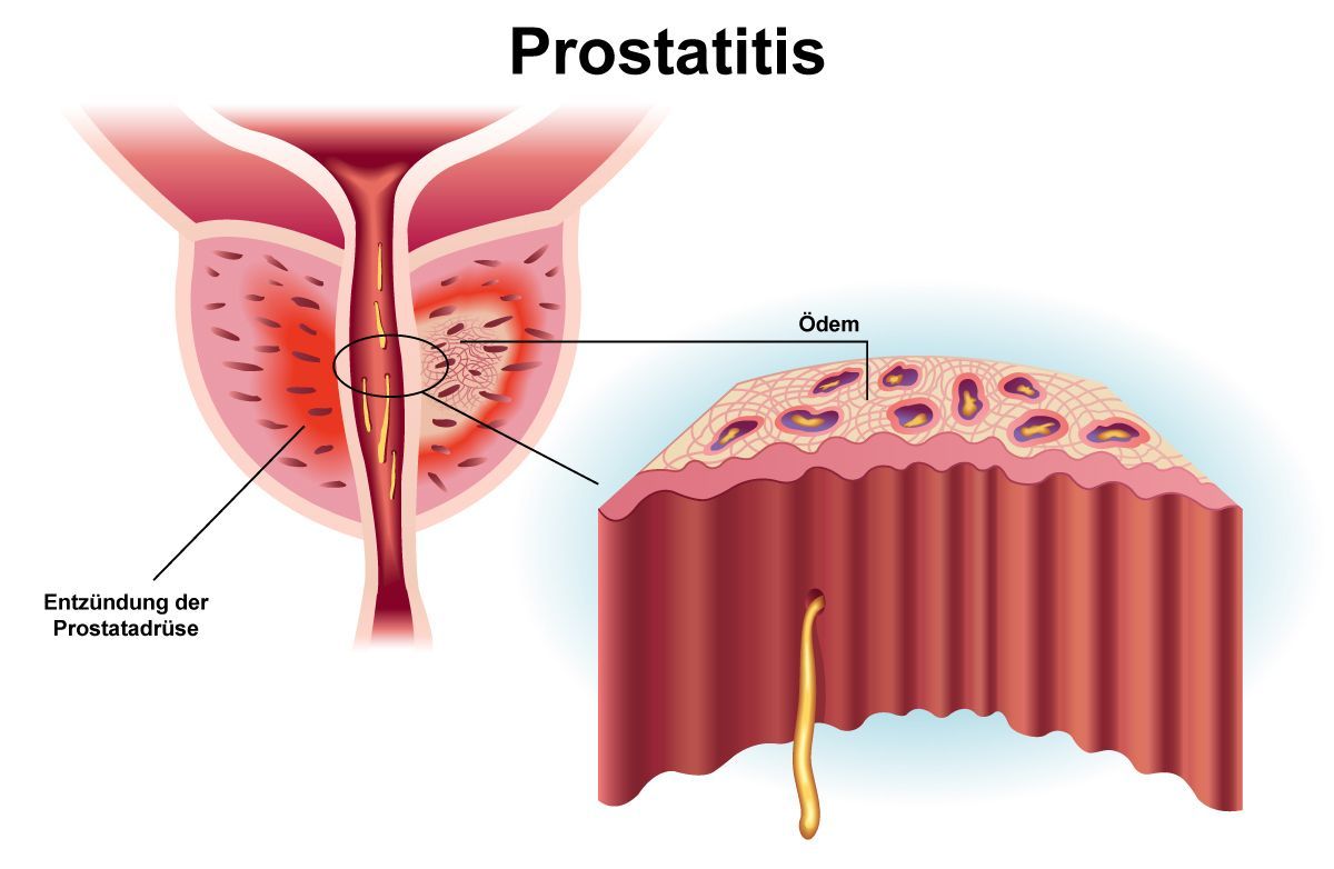 prostatitis therapie)