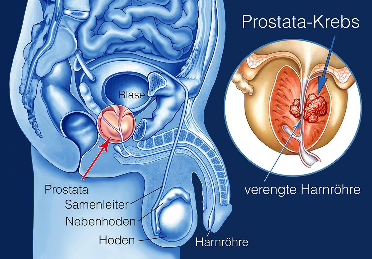 prostatakrebs behandlung)