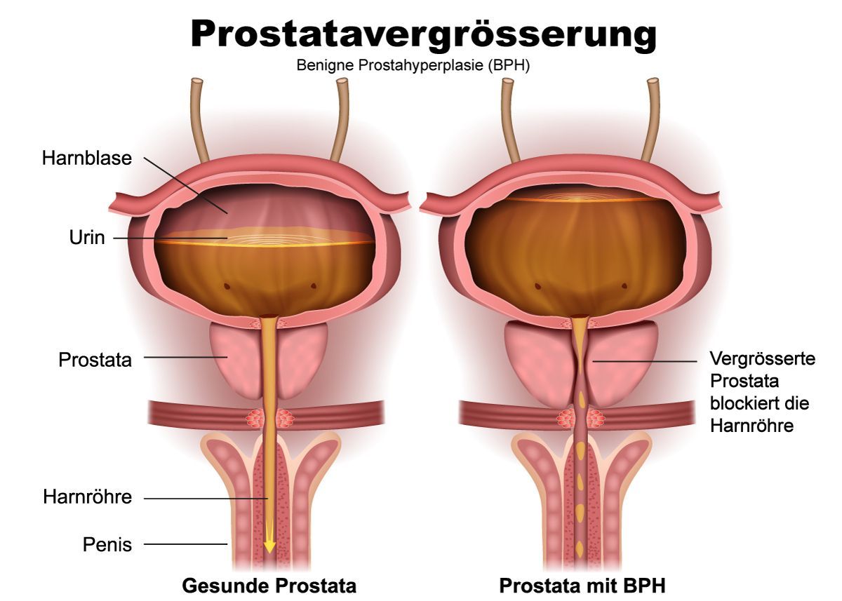 prostata medikamente nebenwirkungen Fogalom krónikus prosztatitis