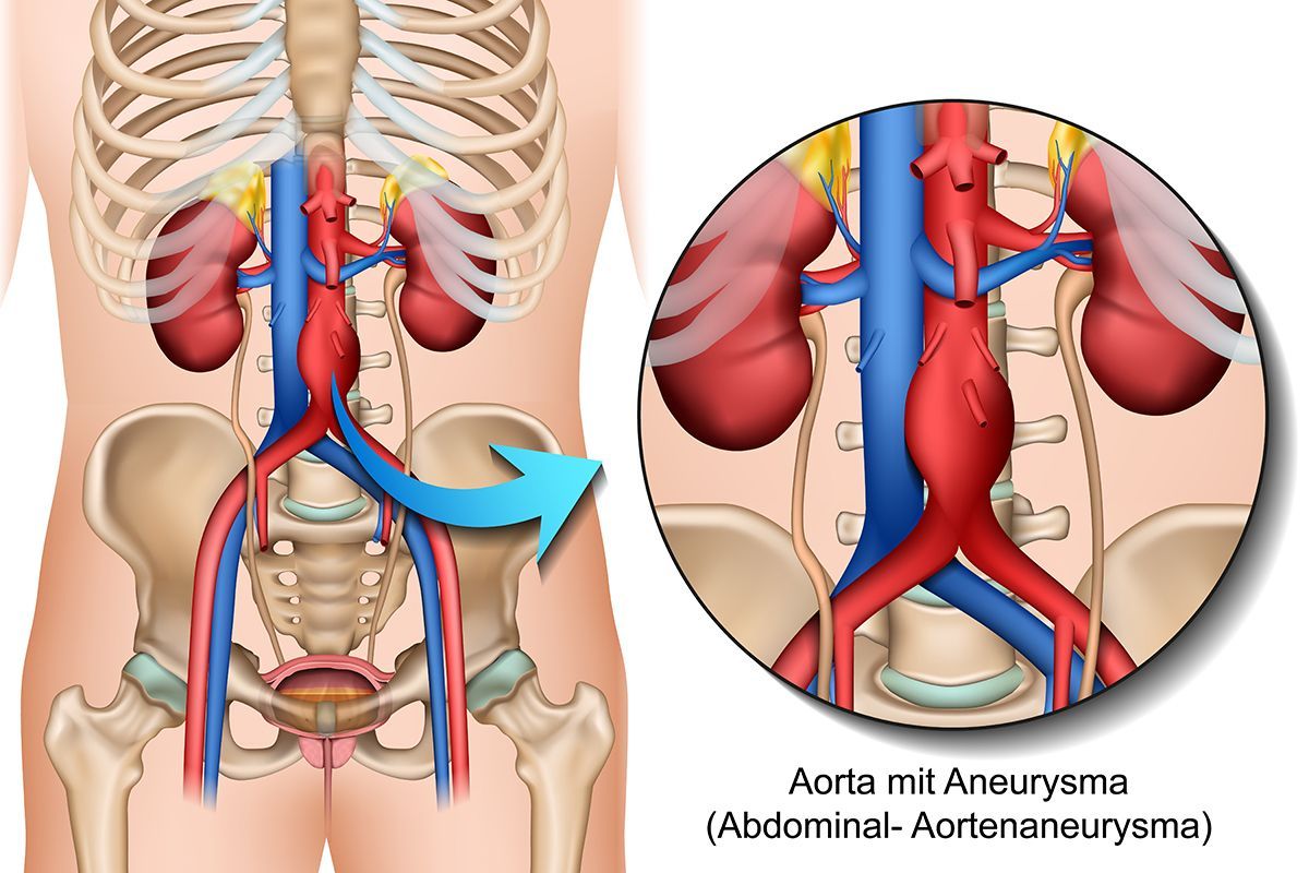 Aneurysma Bauchschlagader Bauchaortenaneurysma Ksw