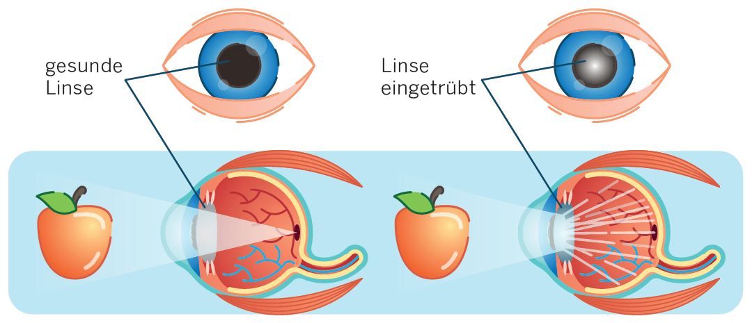 Grauer Star: Ursachen, Operationsmöglichkeit und passende Linsen für die  Augenkrankheit im Alter