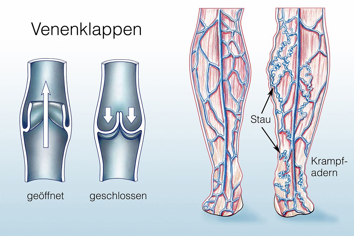 Illustration Venenklappen / Krampfadern KSW 