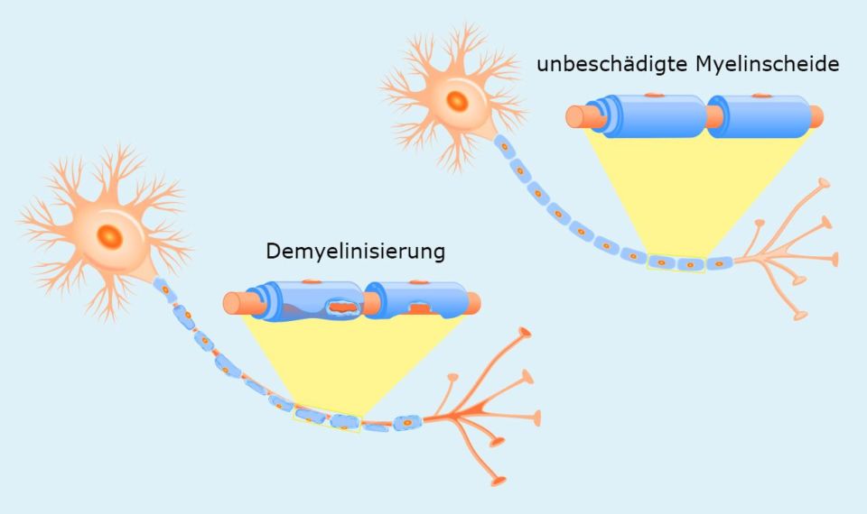 Multiple Sklerose (MS) Symptome, Diagnose und Behandlung KSW