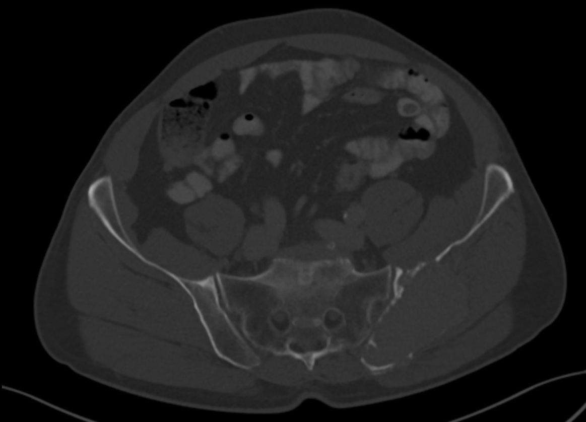 Ct Multiples Myelom Ksw