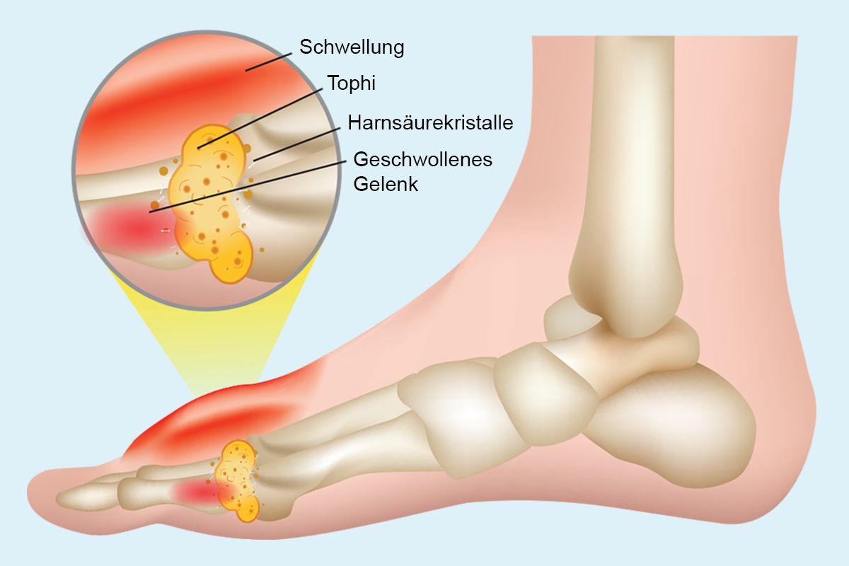 Gicht / Arthritis Urica