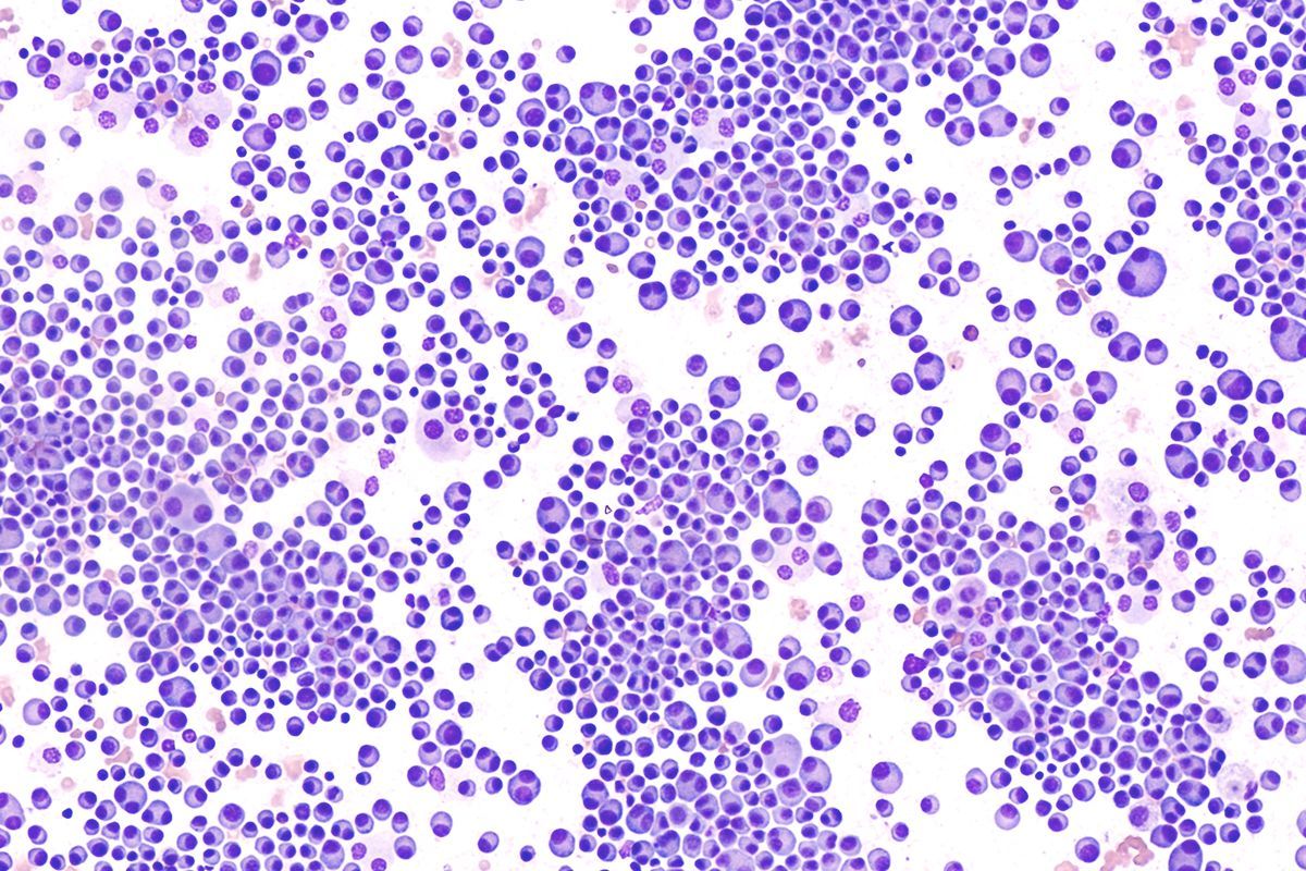 Multiples Myelom Plasmozytom Ksw