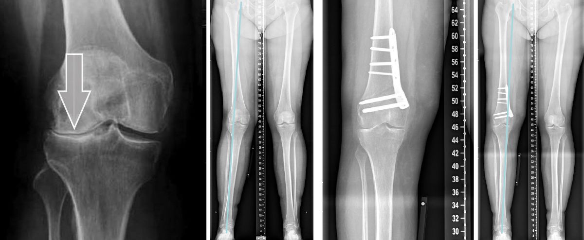 Kniearthrose bei Fehlstellungen - Krankheitsbild und Behandlung - KSW