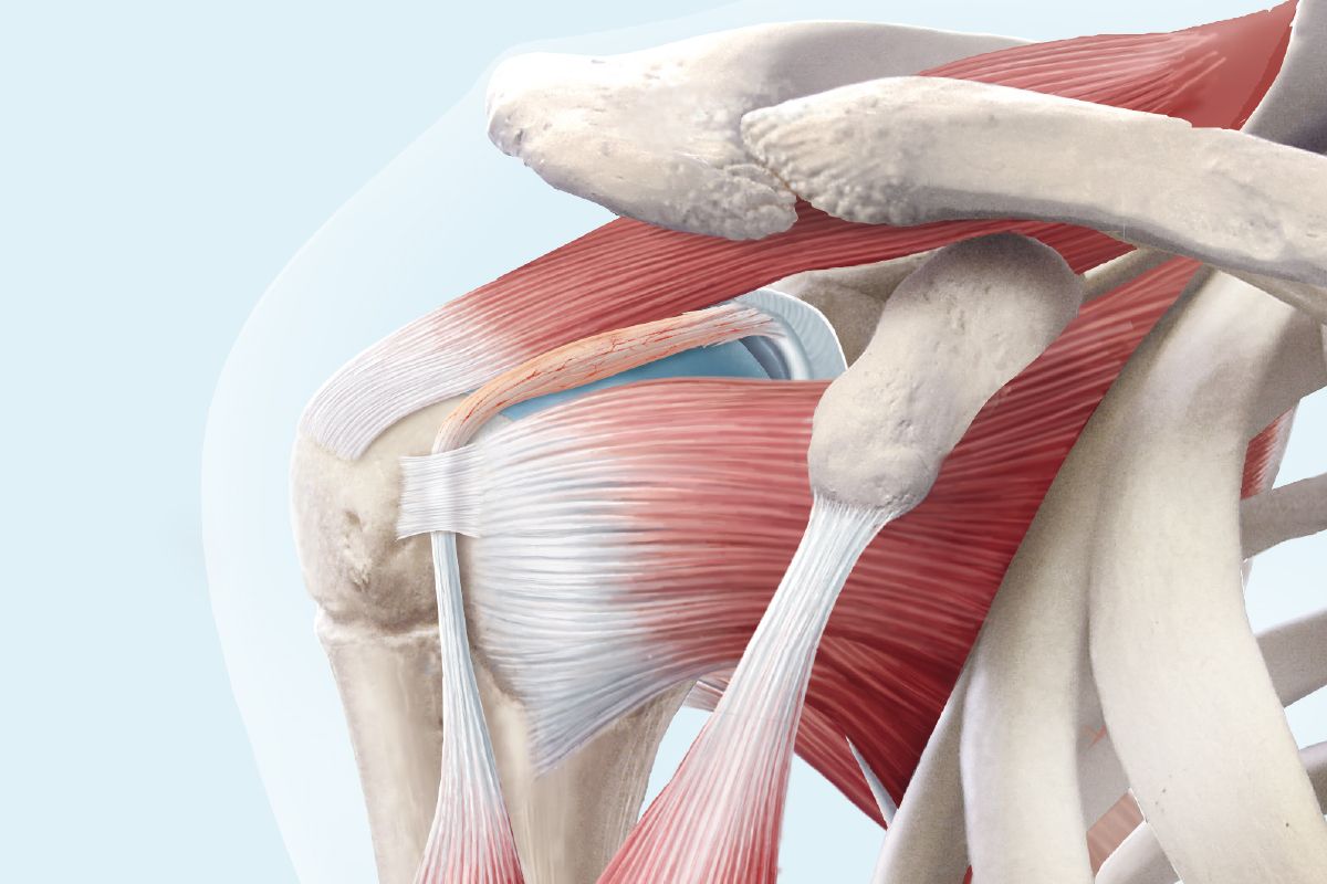 Impingement / Arthrose