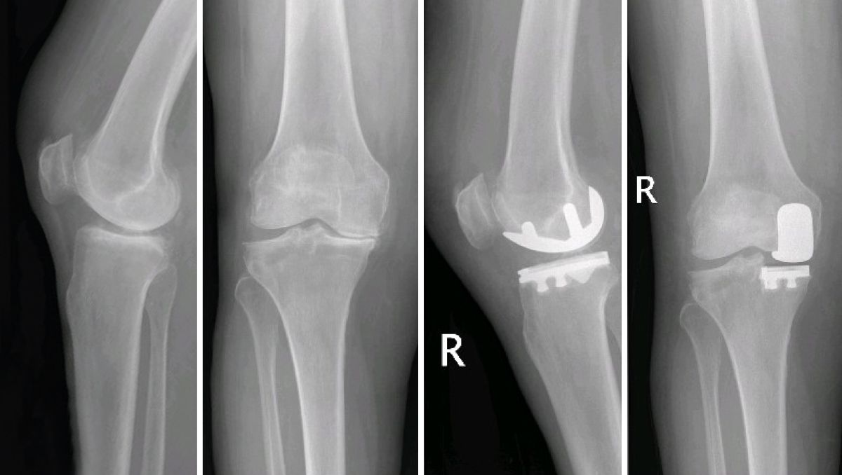 Knieprothese - Operation, Vorgehen und Nachsorge