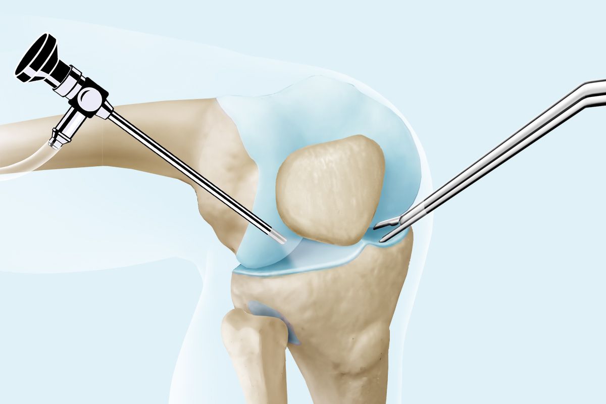 Fäden ziehen nach knie arthroskopie