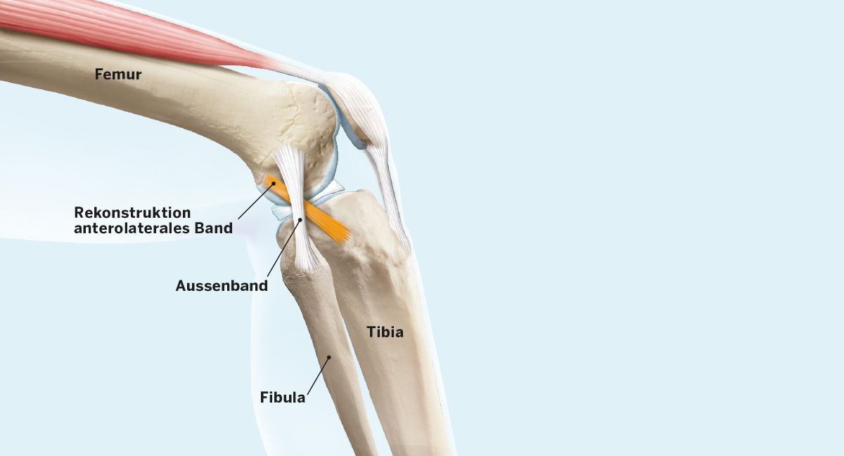 Vorderer Kreuzbandriss: Rekonstruktion Anterolaterales Band KSW