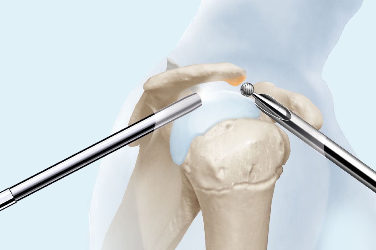 Schultergelenkspiegelung: Acromioplastik KSW