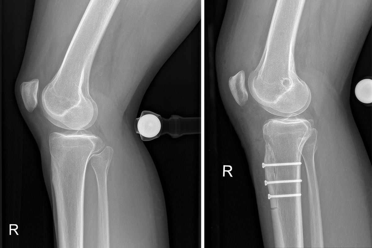Patellaluxation: Tuberositas Osteotomie KSW