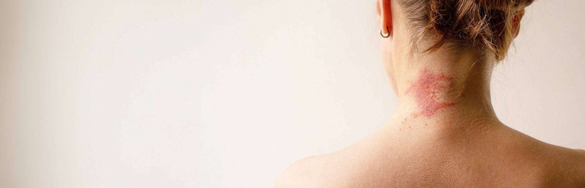 Dermatitis als roter Fleck am Hals einer Frau