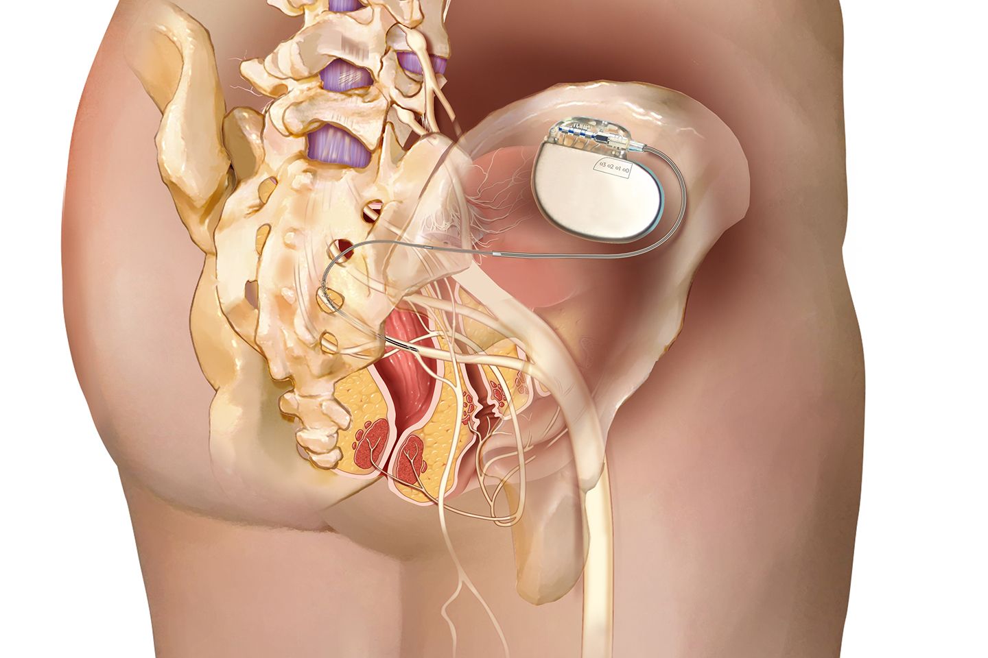 Stuhlinkontinenz Neue Lebensqualitaet Durch Elektrostimulation Ksw Storys 01