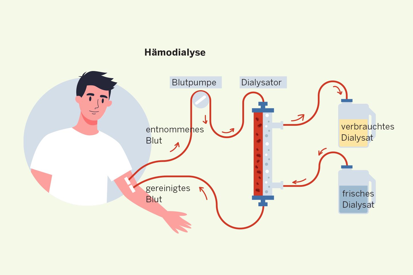 Illustration Hämodialyse