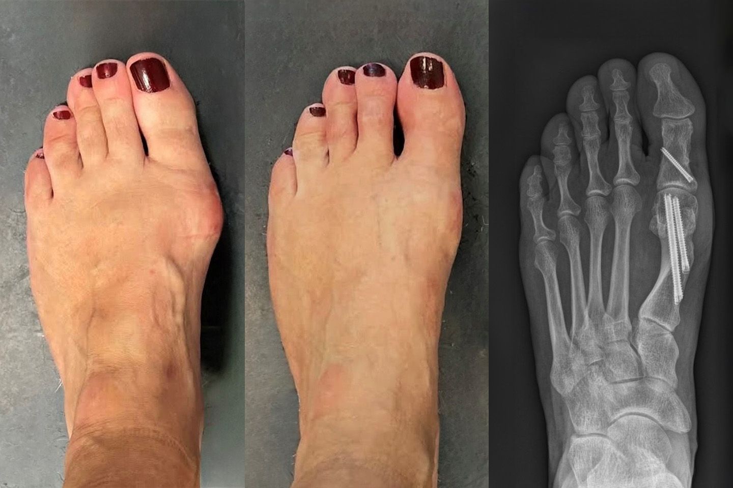 Vorher- / Nachher-Bilder einer minimal-invasiven Korrektur des Hallux valgus.