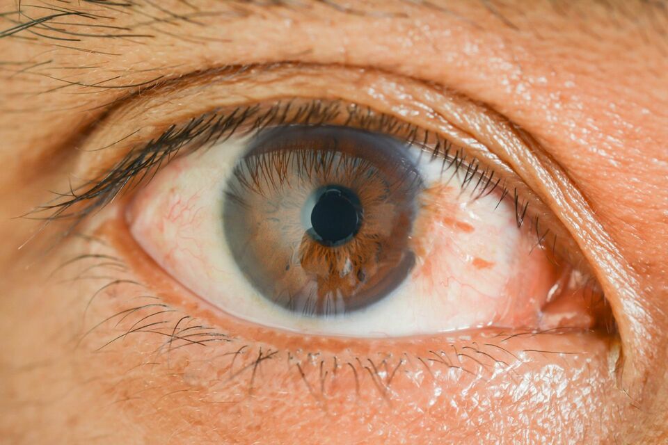 Pterygium Kantonsspital Winterthur