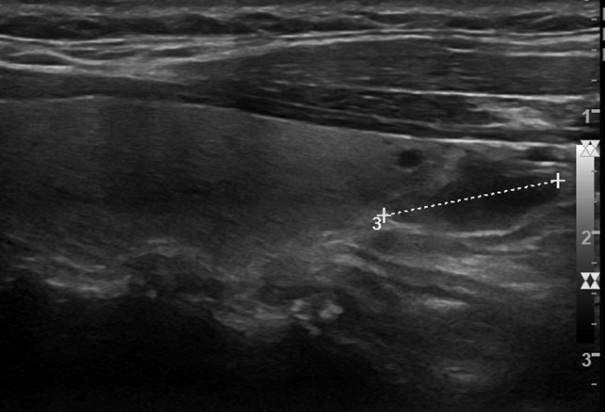 Nebenschilddrüsenadenom im Ultraschall, angrenzend an die Schilddrüse