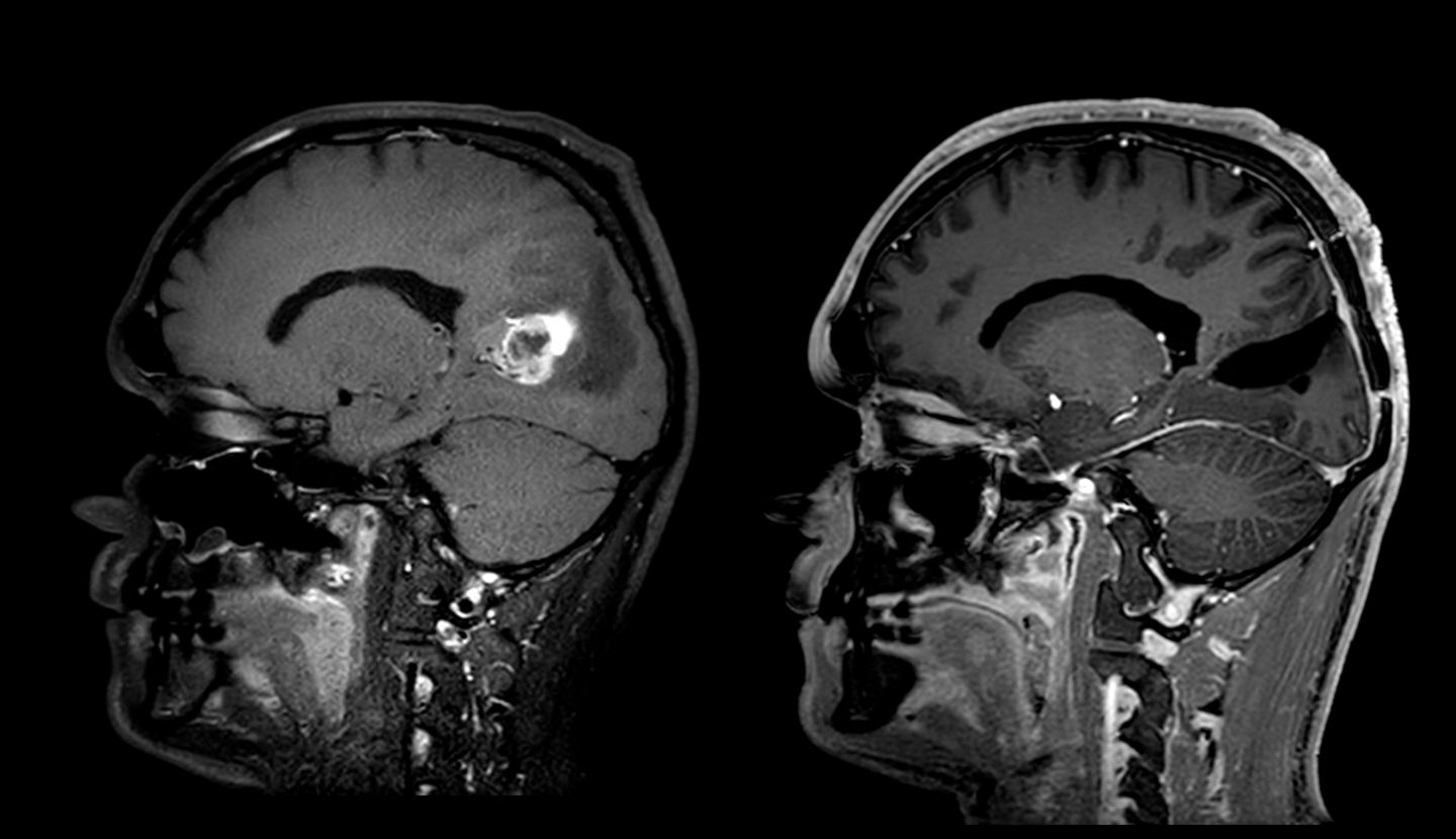 Darstellung eines Glioblastoms (Hirntumor) vor Operation (links) und nach Entfernung (rechts).