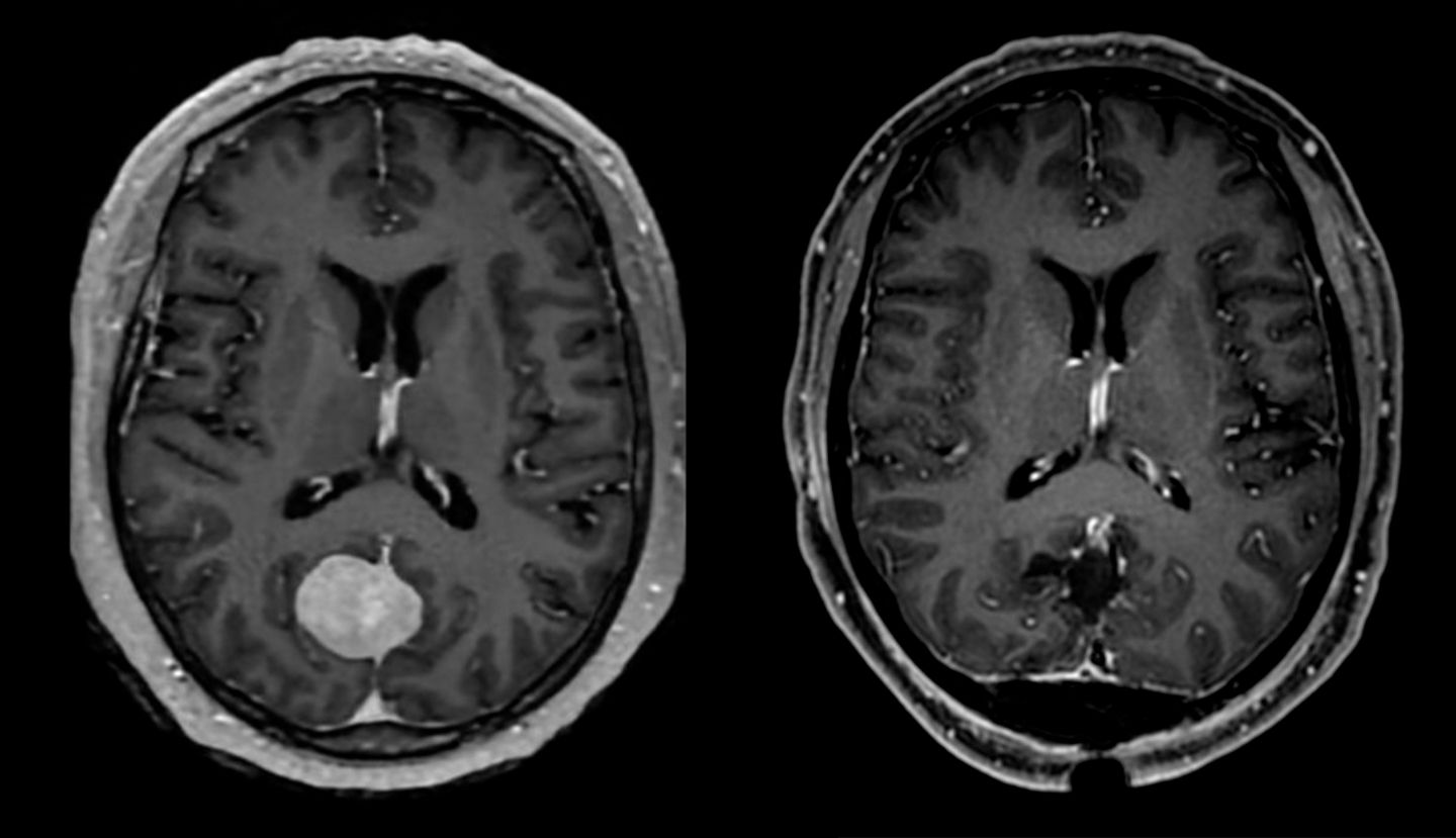 Darstellung eines Meningeoms (Hirntumor) vor Operation (links) und nach Entfernung (rechts).